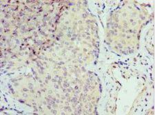 SEPT6 / Septin 6 Antibody - Immunohistochemistry of paraffin-embedded human cervical cancer using antibody at 1:100 dilution.