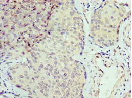 SEPT6 / Septin 6 Antibody - Immunohistochemistry of paraffin-embedded human cervical cancer using SEPT6 Antibody at dilution of 1:100