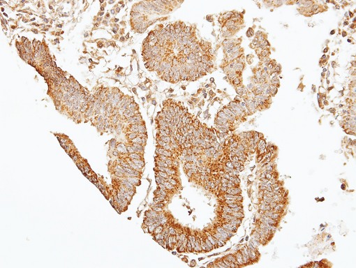 SEPT7 / Septin 7 Antibody - IHC of paraffin-embedded GASTRIC CA using 39331 antibody at 1:100 dilution.
