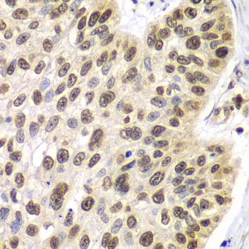 SEPT7 / Septin 7 Antibody - Immunohistochemistry of paraffin-embedded human lung cancer tissue.