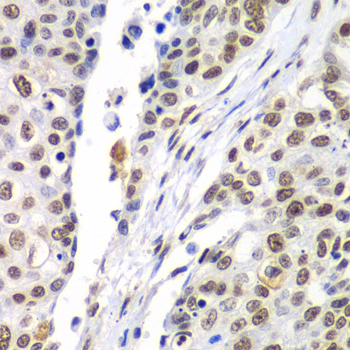 SEPT7 / Septin 7 Antibody - Immunohistochemistry of paraffin-embedded human lung cancer tissue.