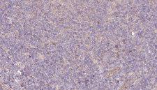 SEPT9 / Septin 9 Antibody - 1:100 staining human lymph carcinoma tissue by IHC-P. The sample was formaldehyde fixed and a heat mediated antigen retrieval step in citrate buffer was performed. The sample was then blocked and incubated with the antibody for 1.5 hours at 22°C. An HRP conjugated goat anti-rabbit antibody was used as the secondary.