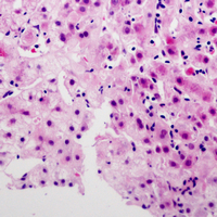 SERINC2 Antibody - Immunohistochemical analysis of SERINC2 staining in human liver cancer formalin fixed paraffin embedded tissue section. The section was pre-treated using heat mediated antigen retrieval with sodium citrate buffer (pH 6.0). The section was then incubated with the antibody at room temperature and detected using an HRP conjugated compact polymer system. AEC was used as the chromogen. The section was then counterstained with hematoxylin and mounted with DPX.