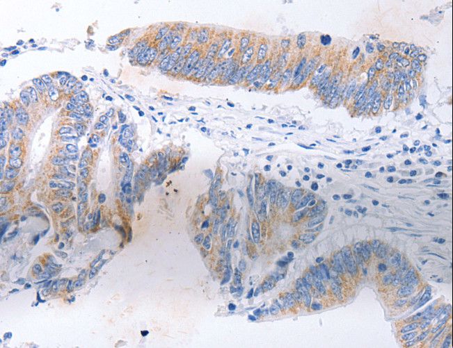 SERP1 Antibody - Immunohistochemistry of paraffin-embedded Human lung cancer using SERP1 Polyclonal Antibody at dilution of 1:30.