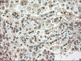 SERPINA1 / Alpha 1 Antitrypsin Antibody - IHC of paraffin-embedded Carcinoma of kidney tissue using anti-SERPINA1 mouse monoclonal antibody. (Dilution 1:50).
