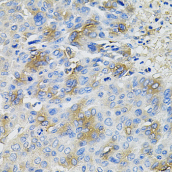 SERPINA1 / Alpha 1 Antitrypsin Antibody - Immunohistochemistry of paraffin-embedded human liver cancer using SERPINA1 antibodyat dilution of 1:100 (40x lens).