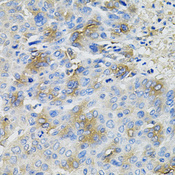 SERPINA1 / Alpha 1 Antitrypsin Antibody - Immunohistochemistry of paraffin-embedded human liver cancer using SERPINA1 antibodyat dilution of 1:100 (40x lens).