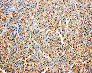 SERPINA4 / Kallistatin Antibody - SERPINA4 / Kallistatin antibody. IHC(P): Human Liver Cancer Tissue.