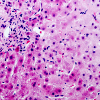 SERPINA5 / PCI Antibody - Immunohistochemical analysis of PAI3 staining in human liver cancer formalin fixed paraffin embedded tissue section. The section was pre-treated using heat mediated antigen retrieval with sodium citrate buffer (pH 6.0). The section was then incubated with the antibody at room temperature and detected using an HRP conjugated compact polymer system. AEC was used as the chromogen. The section was then counterstained with hematoxylin and mounted with DPX.