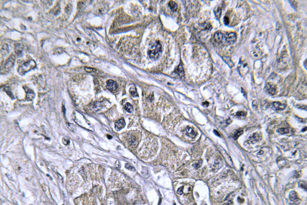 SERPINA5 / PCI Antibody - IHC of PAI-3 (L291) pAb in paraffin-embedded human liver carcinoma.