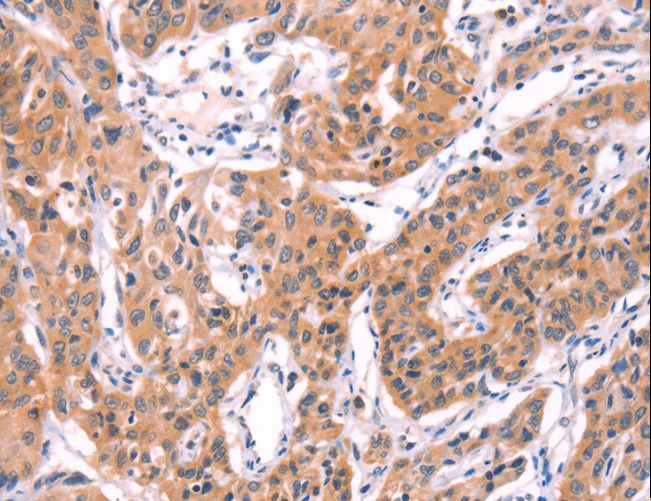 SERPINA5 / PCI Antibody - Immunohistochemistry of paraffin-embedded Human lung cancer using SERPINA5 Polyclonal Antibody at dilution of 1:40.