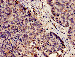 SERPINA5 / PCI Antibody - Immunohistochemistry analysis of human ovarian cancer at a dilution of 1:100