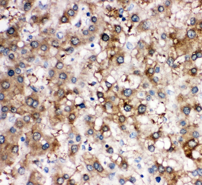 SERPINA6 / CBG Antibody - IHC analysis of Cortisol Binding Globulin using anti-Cortisol Binding Globulin antibody. Cortisol Binding Globulin was detected in paraffin-embedded section of human liver cancer tissue. Heat mediated antigen retrieval was performed in citrate buffer (pH6, epitope retrieval solution) for 20 mins. The tissue section was blocked with 10% goat serum. The tissue section was then incubated with 1µg/ml rabbit anti-Cortisol Binding Globulin antibody overnight at 4°C. Biotinylated goat anti-rabbit IgG was used as secondary antibody and incubated for 30 minutes at 37°C. The tissue section was developed using Strepavidin-Biotin-Complex (SABC) with DAB as the chromogen.