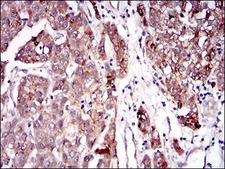 SERPINA7 / TBG Antibody - IHC of paraffin-embedded liver cancer tissues using SERPINA7 mouse monoclonal antibody with DAB staining.