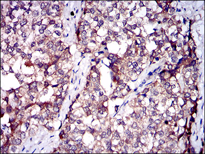 SERPINA7 / TBG Antibody - IHC of paraffin-embedded bladder cancer tissues using SERPINA7 mouse monoclonal antibody with DAB staining.