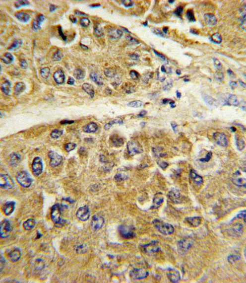SERPINA7 / TBG Antibody - Formalin-fixed and paraffin-embedded human hepatocarcinoma reacted with SERPINA7 Antibody , which was peroxidase-conjugated to the secondary antibody, followed by DAB staining. This data demonstrates the use of this antibody for immunohistochemistry; clinical relevance has not been evaluated.