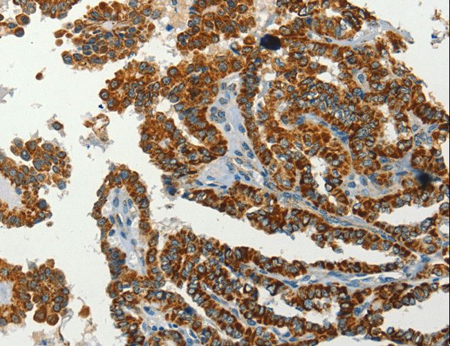 SERPINA9 Antibody - Immunohistochemistry of paraffin-embedded Human thyroid cancer using SERPINA9 Polyclonal Antibody at dilution of 1:60.