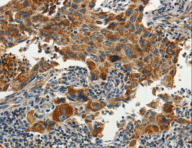 SERPINA9 Antibody - Immunohistochemistry of paraffin-embedded Human lung cancer using SERPINA9 Polyclonal Antibody at dilution of 1:60.