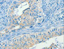 SERPINA9 Antibody - Immunohistochemistry of paraffin-embedded Human cervical cancer using SERPINA9 Polyclonal Antibody at dilution of 1:60.