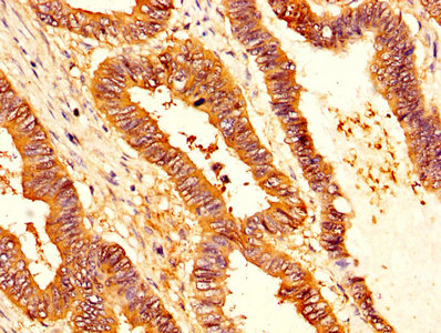 SERPINB1 Antibody - IHC image of SERPINB1 Antibody diluted at 1:200 and staining in paraffin-embedded human colon cancer performed on a Leica BondTM system. After dewaxing and hydration, antigen retrieval was mediated by high pressure in a citrate buffer (pH 6.0). Section was blocked with 10% normal goat serum 30min at RT. Then primary antibody (1% BSA) was incubated at 4°C overnight. The primary is detected by a biotinylated secondary antibody and visualized using an HRP conjugated SP system.