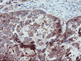 SERPINB1 Antibody - IHC of paraffin-embedded Adenocarcinoma of Human ovary tissue using anti-SERPINB1 mouse monoclonal antibody. (Heat-induced epitope retrieval by 10mM citric buffer, pH6.0, 100C for 10min).