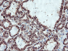 SERPINB1 Antibody - IHC of paraffin-embedded Carcinoma of Human thyroid tissue using anti-SERPINB1 mouse monoclonal antibody. (Heat-induced epitope retrieval by 10mM citric buffer, pH6.0, 100C for 10min).