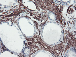 SERPINB1 Antibody - IHC of paraffin-embedded Carcinoma of Human prostate tissue using anti-SERPINB1 mouse monoclonal antibody. (Heat-induced epitope retrieval by 10mM citric buffer, pH6.0, 100C for 10min).