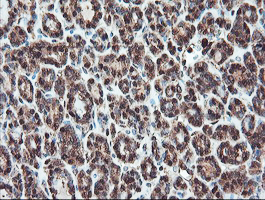 SERPINB1 Antibody - IHC of paraffin-embedded Carcinoma of Human thyroid tissue using anti-SERPINB1 mouse monoclonal antibody.