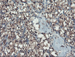 SERPINB1 Antibody - IHC of paraffin-embedded Carcinoma of Human kidney tissue using anti-SERPINB1 mouse monoclonal antibody.
