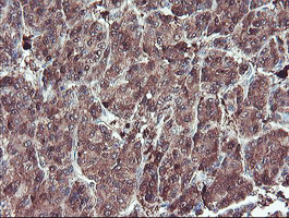 SERPINB1 Antibody - IHC of paraffin-embedded Carcinoma of Human liver tissue using anti-SERPINB1 mouse monoclonal antibody.