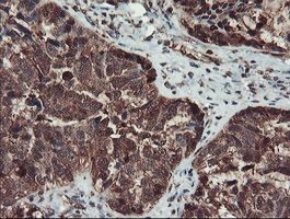 SERPINB1 Antibody - IHC of paraffin-embedded Adenocarcinoma of Human ovary tissue using anti-SERPINB1 mouse monoclonal antibody.