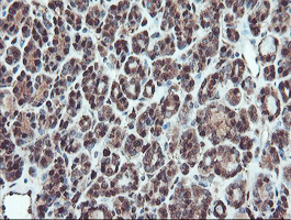 SERPINB1 Antibody - IHC of paraffin-embedded Carcinoma of Human thyroid tissue using anti-SERPINB1 mouse monoclonal antibody.