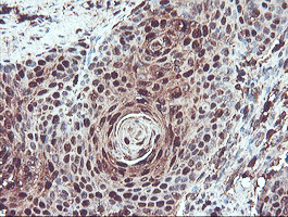 SERPINB1 Antibody - IHC of paraffin-embedded Carcinoma of Human bladder tissue using anti-SERPINB1 mouse monoclonal antibody.
