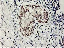 SERPINB13 / HUR7 Antibody - IHC of paraffin-embedded Adenocarcinoma of Human breast tissue using anti-SERPINB13 mouse monoclonal antibody.