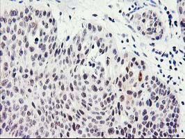 SERPINB13 / HUR7 Antibody - IHC of paraffin-embedded Carcinoma of Human bladder tissue using anti-SERPINB13 mouse monoclonal antibody.