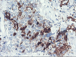 SERPINB2 / PAI-2 Antibody - IHC of paraffin-embedded Adenocarcinoma of Human breast tissue using anti-SERPINB2 mouse monoclonal antibody.