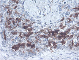 SERPINB2 / PAI-2 Antibody - IHC of paraffin-embedded Adenocarcinoma of Human breast tissue using anti-SERPINB2 mouse monoclonal antibody.