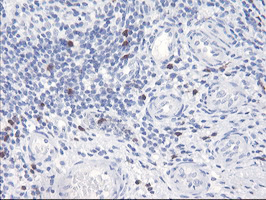 SERPINB2 / PAI-2 Antibody - IHC of paraffin-embedded Carcinoma of Human bladder tissue using anti-SERPINB2 mouse monoclonal antibody.