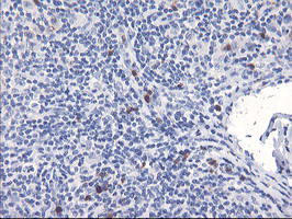 SERPINB2 / PAI-2 Antibody - IHC of paraffin-embedded Human lymphoma tissue using anti-SERPINB2 mouse monoclonal antibody.