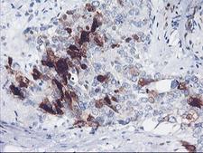 SERPINB2 / PAI-2 Antibody - IHC of paraffin-embedded Adenocarcinoma of Human breast tissue using anti-SERPINB2 mouse monoclonal antibody. (Heat-induced epitope retrieval by 10mM citric buffer, pH6.0, 100C for 10min).