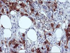 SERPINB2 / PAI-2 Antibody - IHC of paraffin-embedded Carcinoma of Human pancreas tissue using anti-SERPINB2 mouse monoclonal antibody.