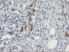 SERPINB2 / PAI-2 Antibody - IHC of paraffin-embedded Carcinoma of Human pancreas tissue using anti-SERPINB2 mouse monoclonal antibody. (Heat-induced epitope retrieval by 10mM citric buffer, pH6.0, 100C for 10min).