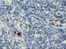 SERPINB2 / PAI-2 Antibody - IHC of paraffin-embedded Human lymphoma tissue using anti-SERPINB2 mouse monoclonal antibody. (Heat-induced epitope retrieval by 10mM citric buffer, pH6.0, 100C for 10min).