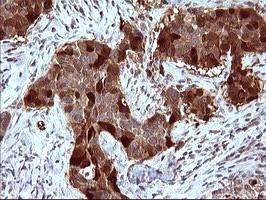 SERPINB3 Antibody - IHC of paraffin-embedded Carcinoma of Human lung tissue using anti-SERPINB3 mouse monoclonal antibody. (Heat-induced epitope retrieval by 10mM citric buffer, pH6.0, 120°C for 3min).