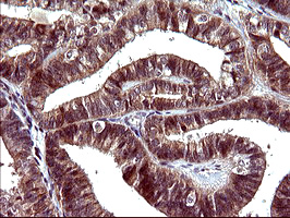 SERPINB3 Antibody - IHC of paraffin-embedded Adenocarcinoma of Human endometrium tissue using anti-SERPINB3 mouse monoclonal antibody. (Heat-induced epitope retrieval by 10mM citric buffer, pH6.0, 120°C for 3min).