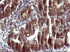 SERPINB3 Antibody - IHC of paraffin-embedded Carcinoma of Human pancreas tissue using anti-SERPINB3 mouse monoclonal antibody. (Heat-induced epitope retrieval by 10mM citric buffer, pH6.0, 120°C for 3min).