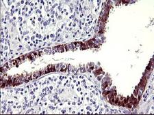SERPINB3 Antibody - IHC of paraffin-embedded Carcinoma of Human prostate tissue using anti-SERPINB3 mouse monoclonal antibody. (Heat-induced epitope retrieval by 10mM citric buffer, pH6.0, 120°C for 3min).