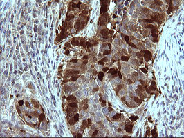 SERPINB3 Antibody - IHC of paraffin-embedded Carcinoma of Human lung tissue using anti-SERPINB3 mouse monoclonal antibody. (Heat-induced epitope retrieval by 10mM citric buffer, pH6.0, 120°C for 3min).