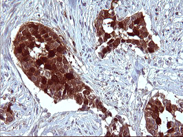 SERPINB3 Antibody - IHC of paraffin-embedded Carcinoma of Human bladder tissue using anti-SERPINB3 mouse monoclonal antibody. (Heat-induced epitope retrieval by 10mM citric buffer, pH6.0, 120°C for 3min).