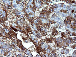 SERPINB3 Antibody - IHC of paraffin-embedded Carcinoma of Human liver tissue using anti-SERPINB3 mouse monoclonal antibody. (Heat-induced epitope retrieval by 10mM citric buffer, pH6.0, 120°C for 3min).